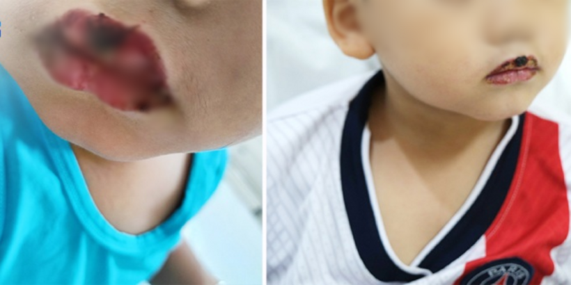 Môi bé P. sưng phồng, loét, chảy mủ, máu khi nhập viện và lành thương sau 5 ngày điều trị. Ảnh: BVCC