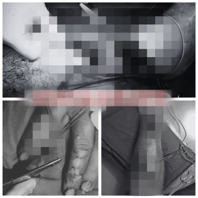 Người đàn ông tổn thương nghiêm trọng sau khi bị máy cưa cứa vào tay