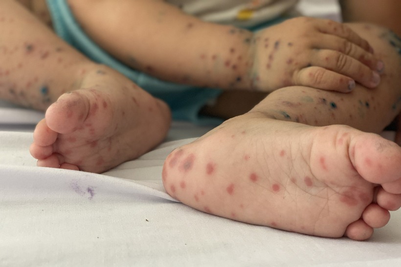 Bệnh tay chân miệng đến nay vẫn chưa có vaccine phòng bệnh. Ảnh minh họa