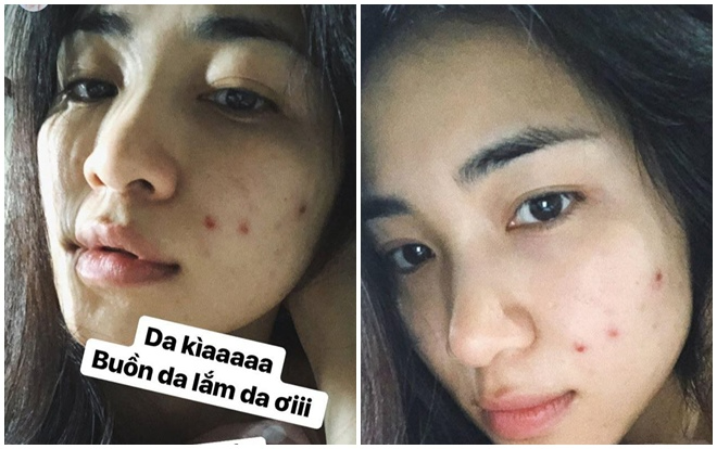 Tình trạng mụn trước đây của Hòa Minzy. Ảnh: Phụ nữ số
