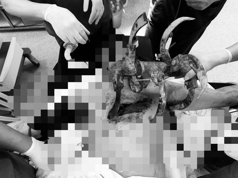 Lưỡi máy cày khiến bệnh nhân tổn thương nặng nề