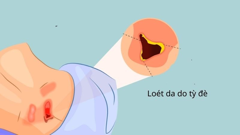 Người bệnh tai biến có thể bị viêm loét da