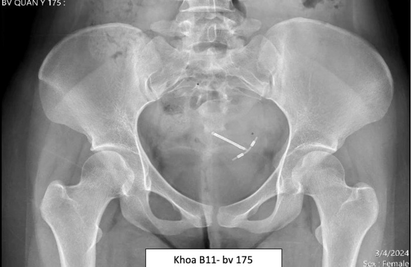 Phim X-quang của bệnh nhân N.T.N.Y. Ảnh: Phụ nữ Việt Nam