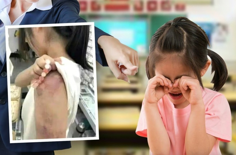 Nữ sinh bị giáo viên đánh bầm tím cánh tay. Ảnh: SCMP