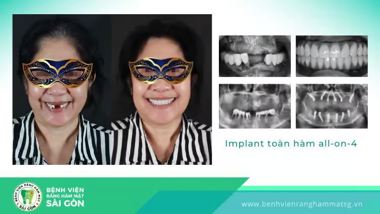 Trồng răng implant có đau không? Khi nào hết đau? - 5
