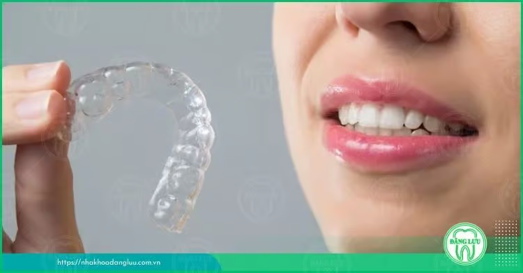 Răng hô nhẹ là thế nào? Có nên niềng răng hô nhẹ? - 1