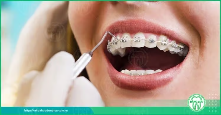 Răng hô nhẹ là thế nào? Có nên niềng răng hô nhẹ? - 3