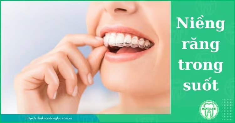 Răng hô nhẹ là thế nào? Có nên niềng răng hô nhẹ? - 4