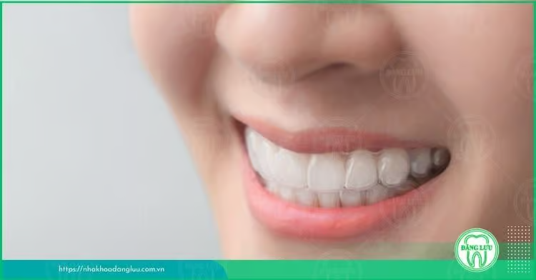 Răng hô nhẹ là thế nào? Có nên niềng răng hô nhẹ? - 5