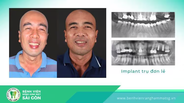 Trồng răng implant có đau không? Khi nào hết đau? - 4