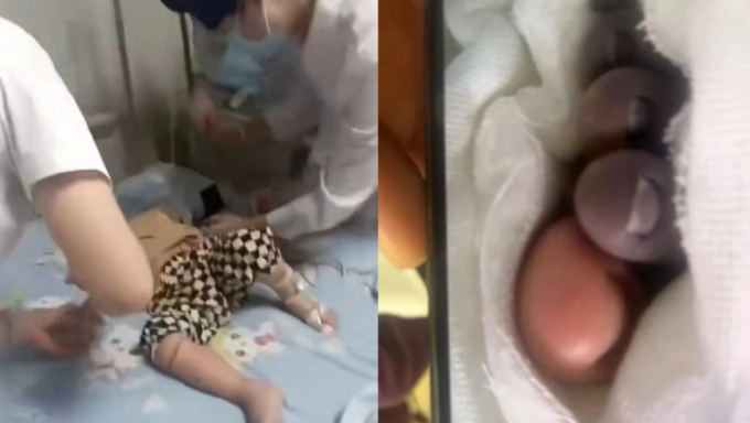 Cậu bé phát sốt, bàn chân phải sưng tấy, sau đó chuyển sau màu đen. Ảnh: QQ.