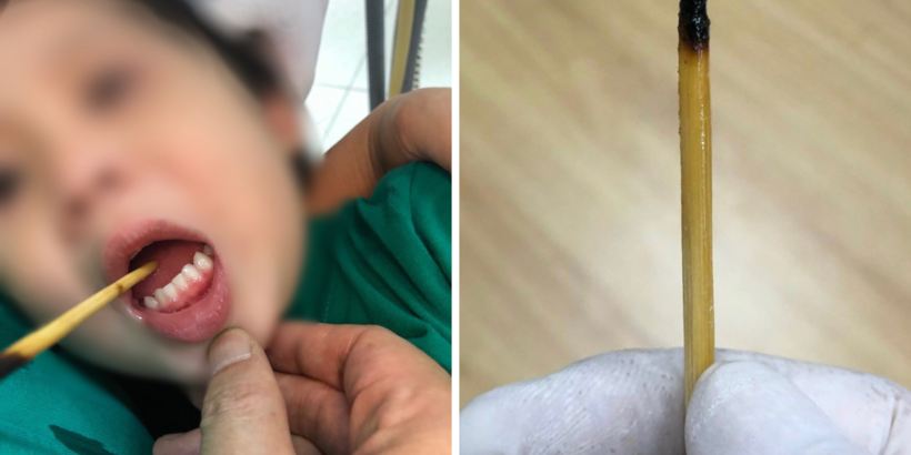 Bé cầm xiên que tự chơi đùa và ngã khiến que đâm vào lưỡi, gây ra thương tích. Ảnh: BVCC