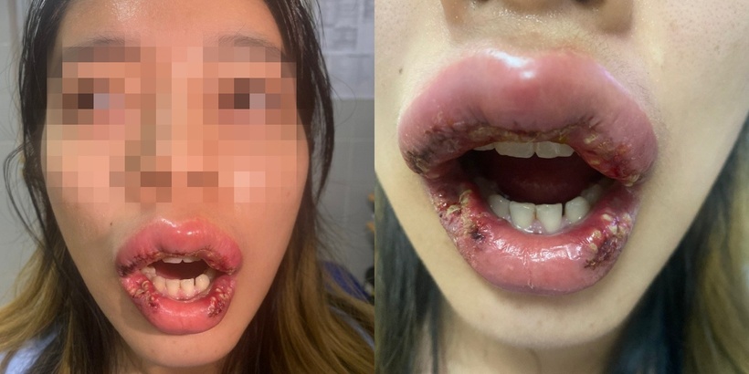 Muốn có môi trái tim khiến cô gái bị biến dạng khuôn mặt vì tin tưởng spa trên mạng. Ảnh: BSCC