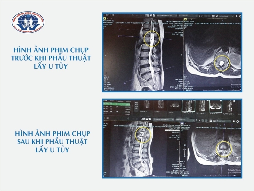 Ảnh phim chụp trước khi và sau khi phẫu thuật lấy u tủy. Ảnh: Gia Đình Việt Nam
