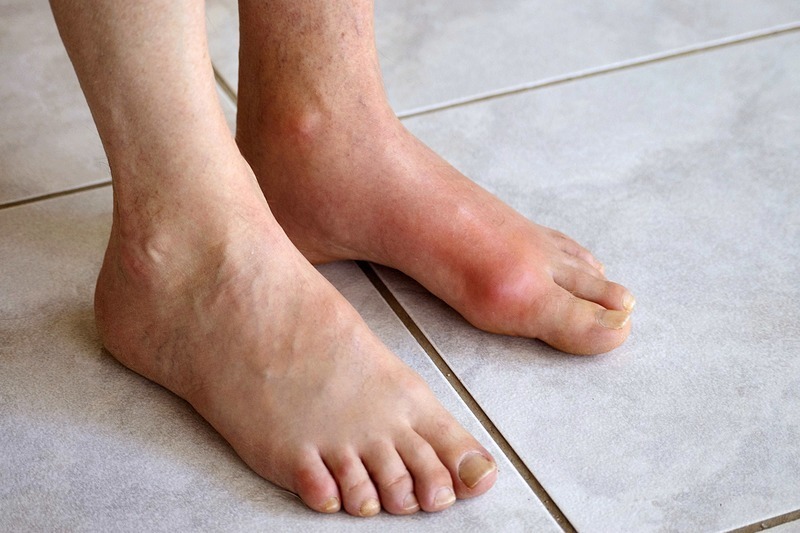 Bệnh gout là một bệnh lý mãn tính nên người bệnh bắt buộc phải chấp nhận sống chung và điều trị suốt đời. Ảnh minh họa