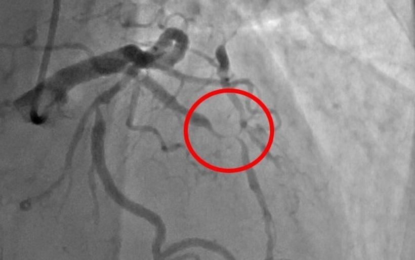 Hình ảnh mạch vành người bệnh trước can thiệp. Ảnh: VTV Times