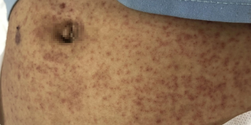 Bệnh nhân xuất hiện mụn nước và nhiều mụn mủ toàn thân, loét miệng họng, ý thức chậm, yếu hai chân, chướng bụng liệt ruột. Ảnh: BVCC