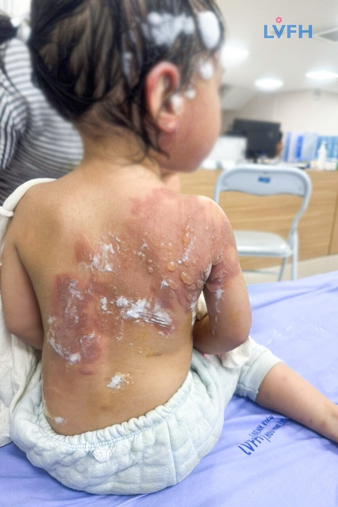 Vào viện, bé trong tình trạng đau, quấy khóc nhiều, bỏng, phồng rộp nhiều vị trí, loét, chảy dịch, mất da. Ảnh: BVCC.