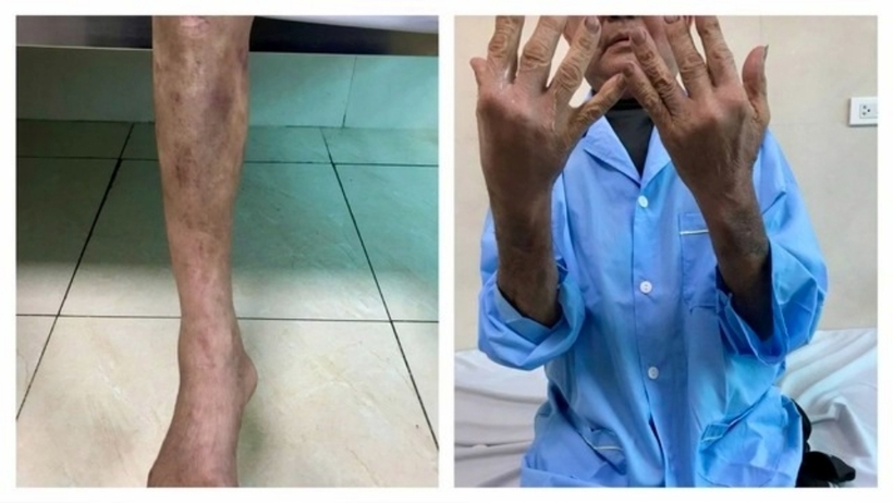 Chân tay bệnh nhân bị teo nhỏ, xuất hiện các vết tím đen. Ảnh: VTV Times