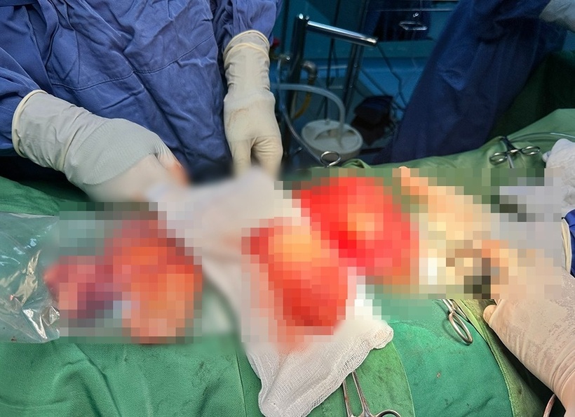 Các bác sĩ đã mổ bóc tách thành công khối u tinh hoàn khủng nặng gần 1kg.