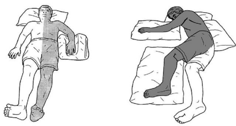 Liệt nửa người là di chứng thường gặp ở người bệnh đột quỵ