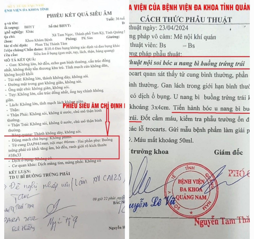 Kết quả siêu âm là u bì buồng trứng phải, còn hồ sơ ra viện ghi phẫu thuật nội soi bóc u nang bì buồng trứng trái. (Ảnh: Tuổi trẻ)