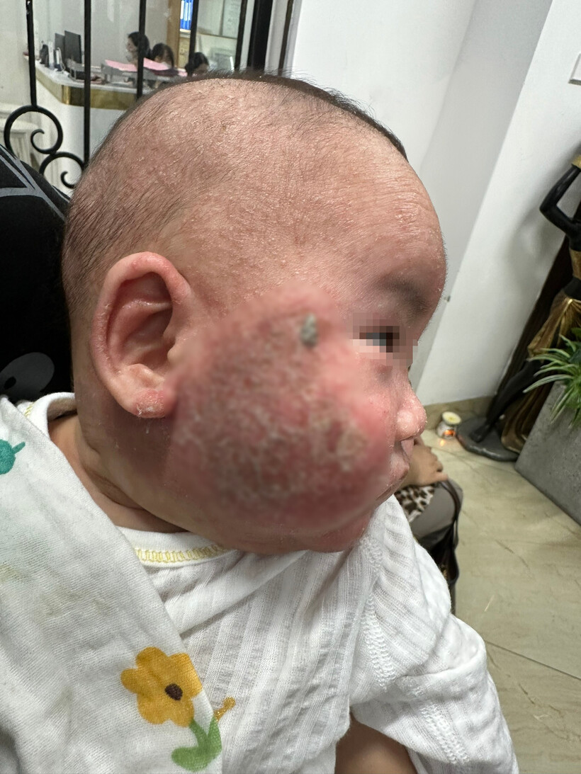 Bé trai nhiễm trùng nặng vì chữa viêm da cơ địa không đúng cách