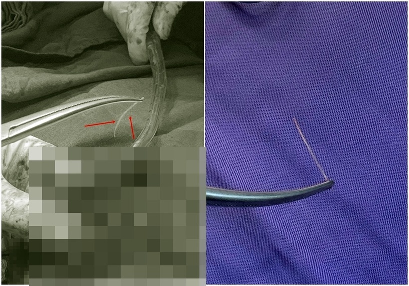 Mảnh xương cá dài 3cm. Ảnh: BVCC.