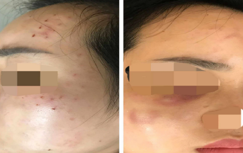 Nữ bệnh nhân bị tiêm nhầm sữa rửa mặt vào da. Ảnh: Sức khỏe Đời sống