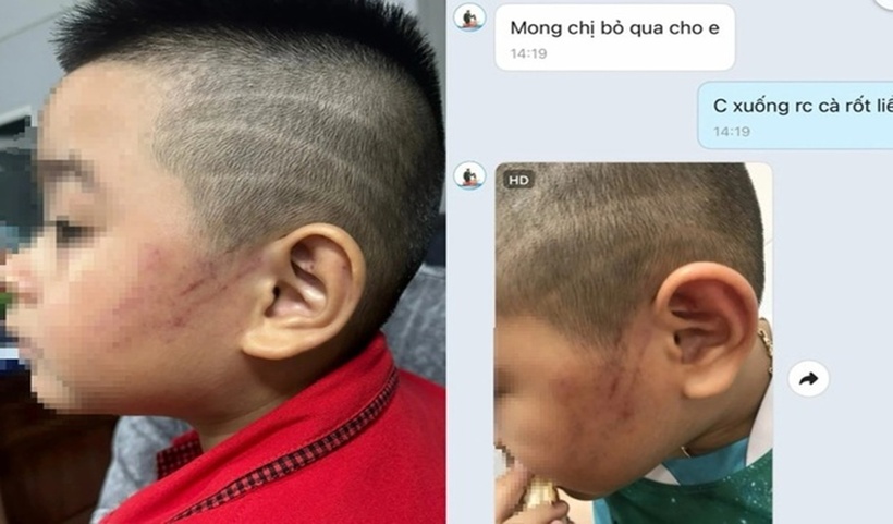 Hình ảnh bé Kh. bầm tím mặt và tin nhắn xin lỗi phụ huynh từ cô giáo. (Ảnh: Thanh niên)