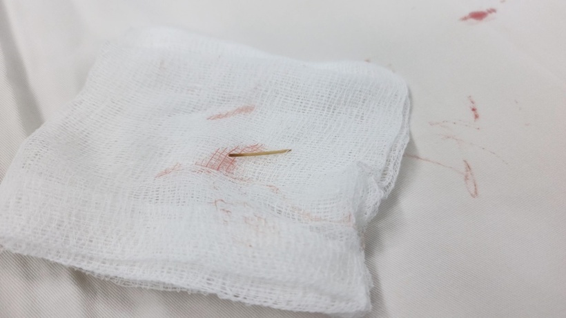 Dị vật dài 0.2 cm x 4 cm (có hình dạng giống tăm xỉa răng) đâm xuyên thủng hồi tràng đoạn cuối ruột non. Ảnh: BVCC.