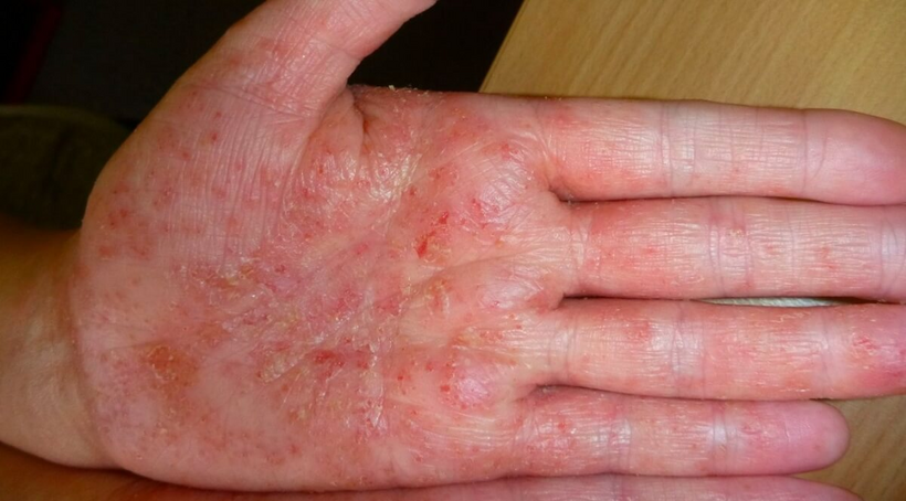 Các vùng da bị tổn thương do bệnh tổ đỉa sẽ khô và có vảy