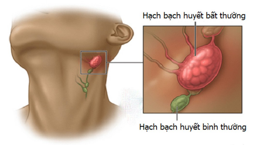 Sưng hạch bạch huyết khi bệnh tổ đỉa ở giai đoạn nặng