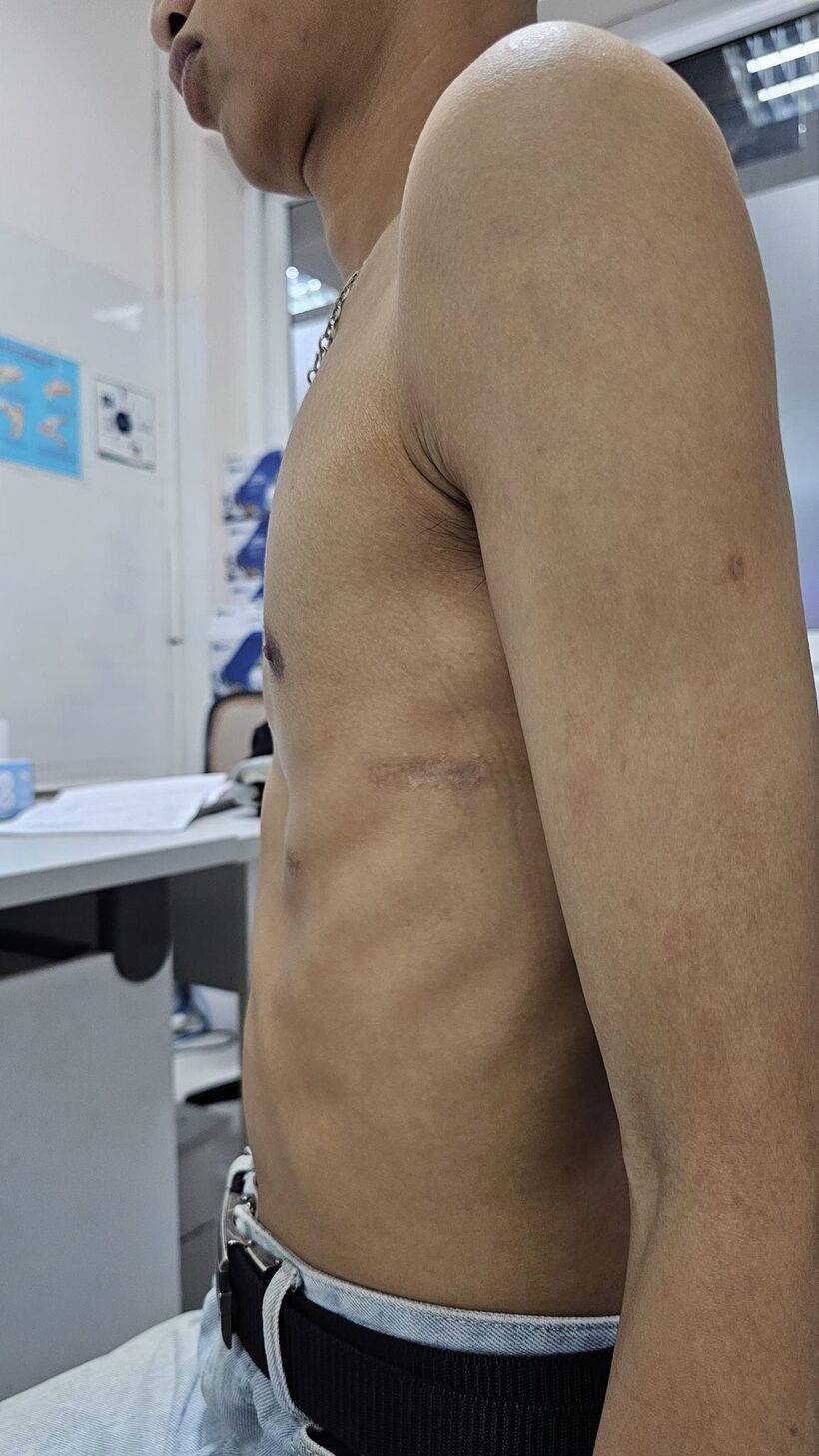 Nam bệnh nhân bị lõm ngực thể nặng. Ảnh: BVCC.