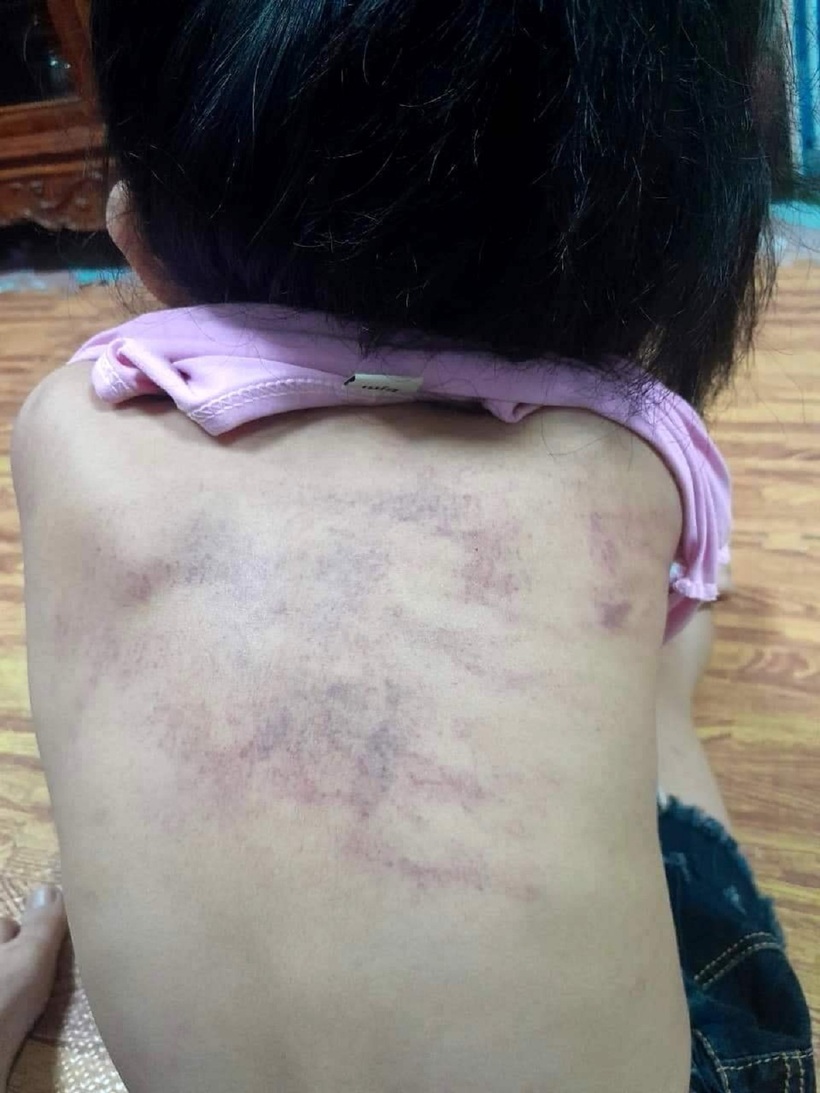 Vết bầm sau lưng cháu bé 5 tuổi. Ảnh: Sức khỏe & Đời sống