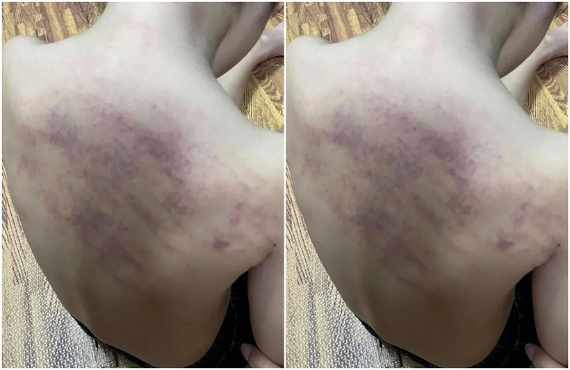 Những vết bầm tím trên cơ thể bé 5 tuổi sau khi đi học ở Hải Phòng. Ảnh: VTC News