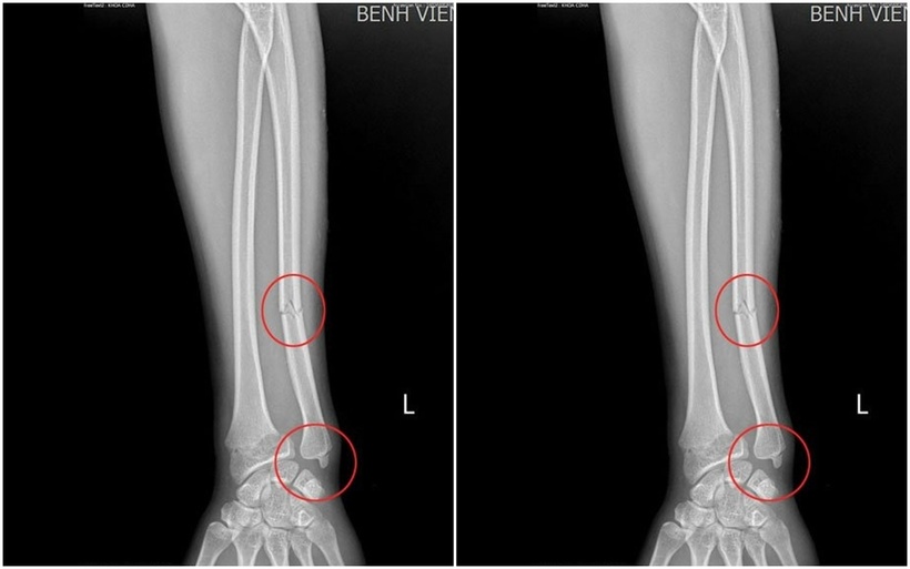 Tổn thương vùng cẳng tay của người bệnh (vùng khoanh tròn màu đỏ). Ảnh: BVCC