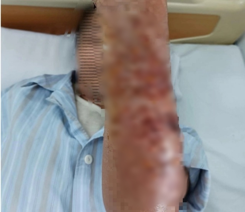 Vết thương vùng cánh tay của người đàn ông bị lở loét. Ảnh: Người Lao Động