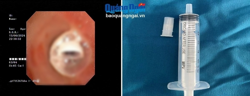 Dị vật là chiếc kèn nhựa mắc trong đường thở của bệnh nhi. Ảnh: Báo Quảng Ngãi