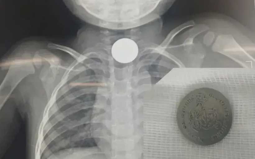 Phim chụp X-quang và dị vật là đồng xu kim loại có kích thước 20mm được gắp ra ngoài. Ảnh: VTV Times