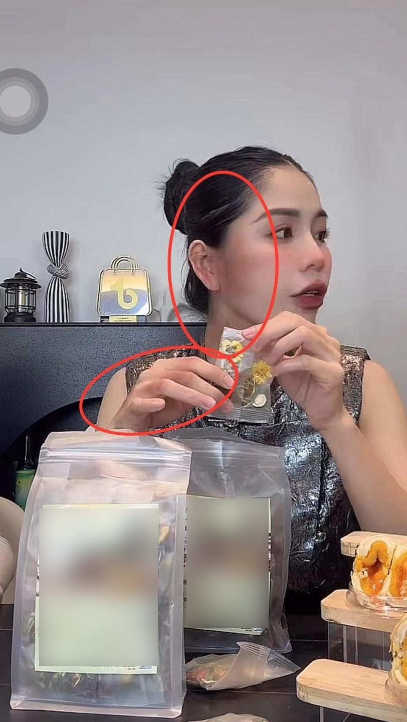Cận cảnh những vết bầm tím trên cơ thể Hằng Du Mục - 2