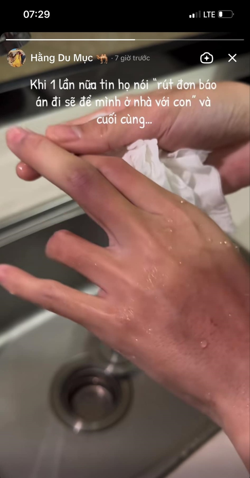 Hằng Du Mục bị chồng đánh bầm tím mặt, đăng story ẩn ý đây không phải lần đầu - 2