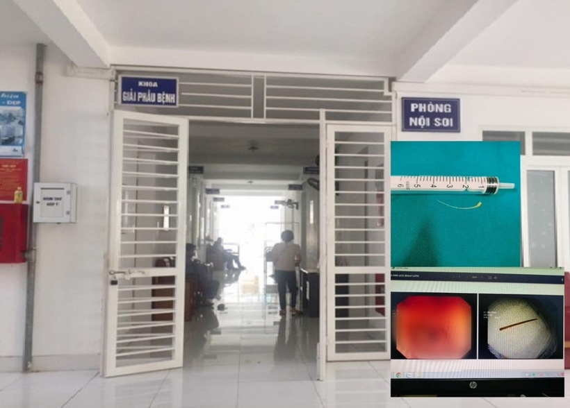 Các bác sĩ hội chẩn và chỉ định nội soi gây mê, gắp thành công dị vật tăm tre dài 4cm, đầu nhọn cắm sâu vào dạ dày của người bệnh. Ảnh: VietNamNet