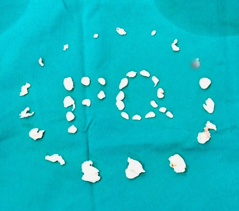 Một phần sỏi được các bác sĩ lấy ra từ vai của bệnh nhân. Ảnh: Sức Khỏe & Đời Sống