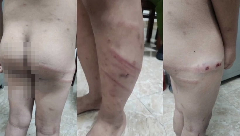 Những vết bầm tím trên cơ thể bé trai 11 tuổi. Ảnh: PLO