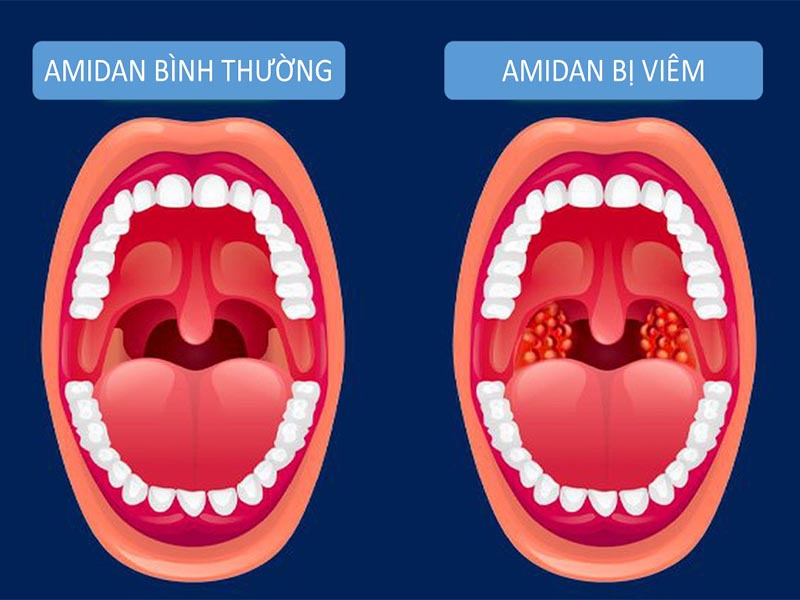 Viêm amidan ở trẻ có thể do vi khuẩn hoặc virus