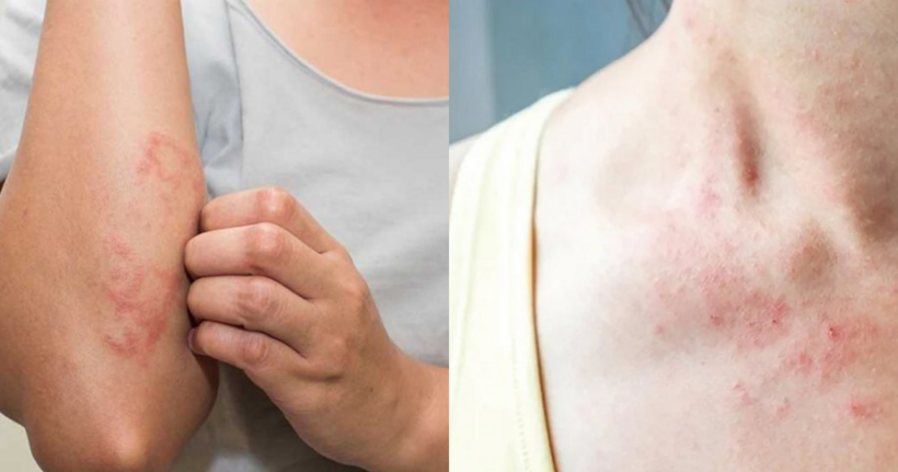 Ngứa da có thể là dấu hiệu cảnh báo bệnh ung thư