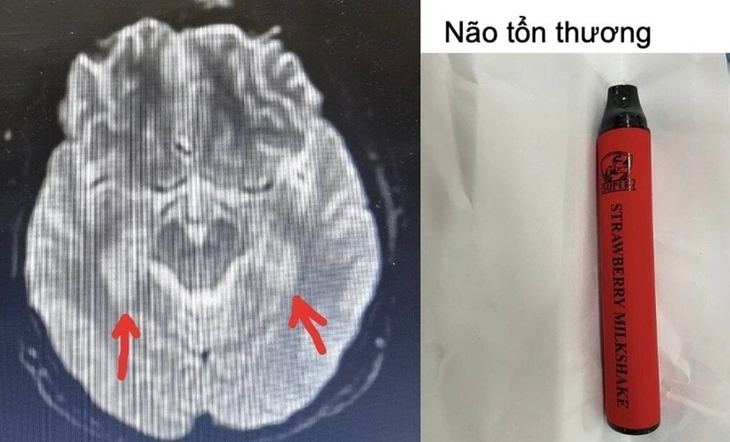 Não của người bệnh tổn thương sau ngộ độc thuốc lá điện tử. Ảnh: Dân Trí