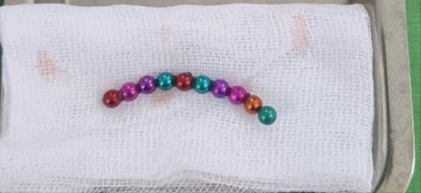 Dị vật lấy ra là chuỗi 10 cục nam châm nhiều màu kích thước mỗi cục khoảng 4-5mm. Ảnh: BVCC.