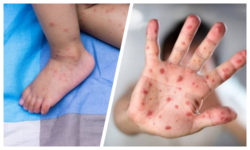 Một số dịch bệnh lưu hành trong nước như sốt xuất huyết, tay chân miệng, sởi đang có xu hướng gia tăng. Ảnh minh họa